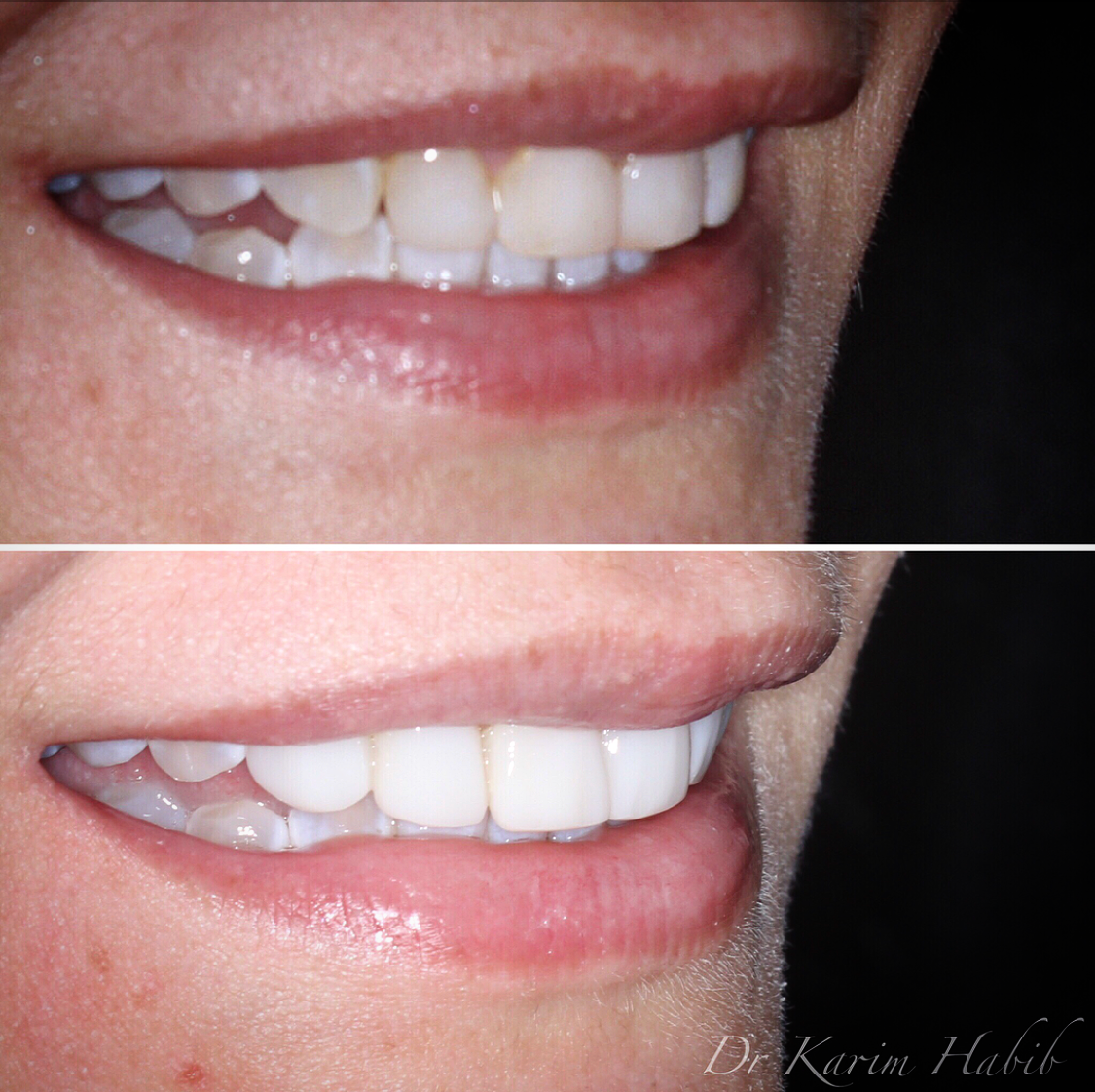 Composite resin veneers profile before and after