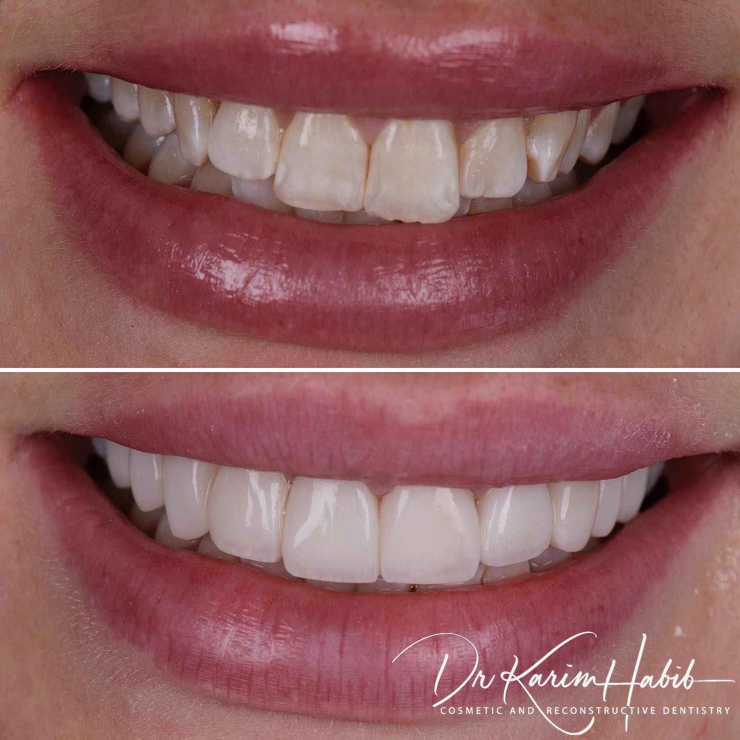 Amazing Smile with Veneers