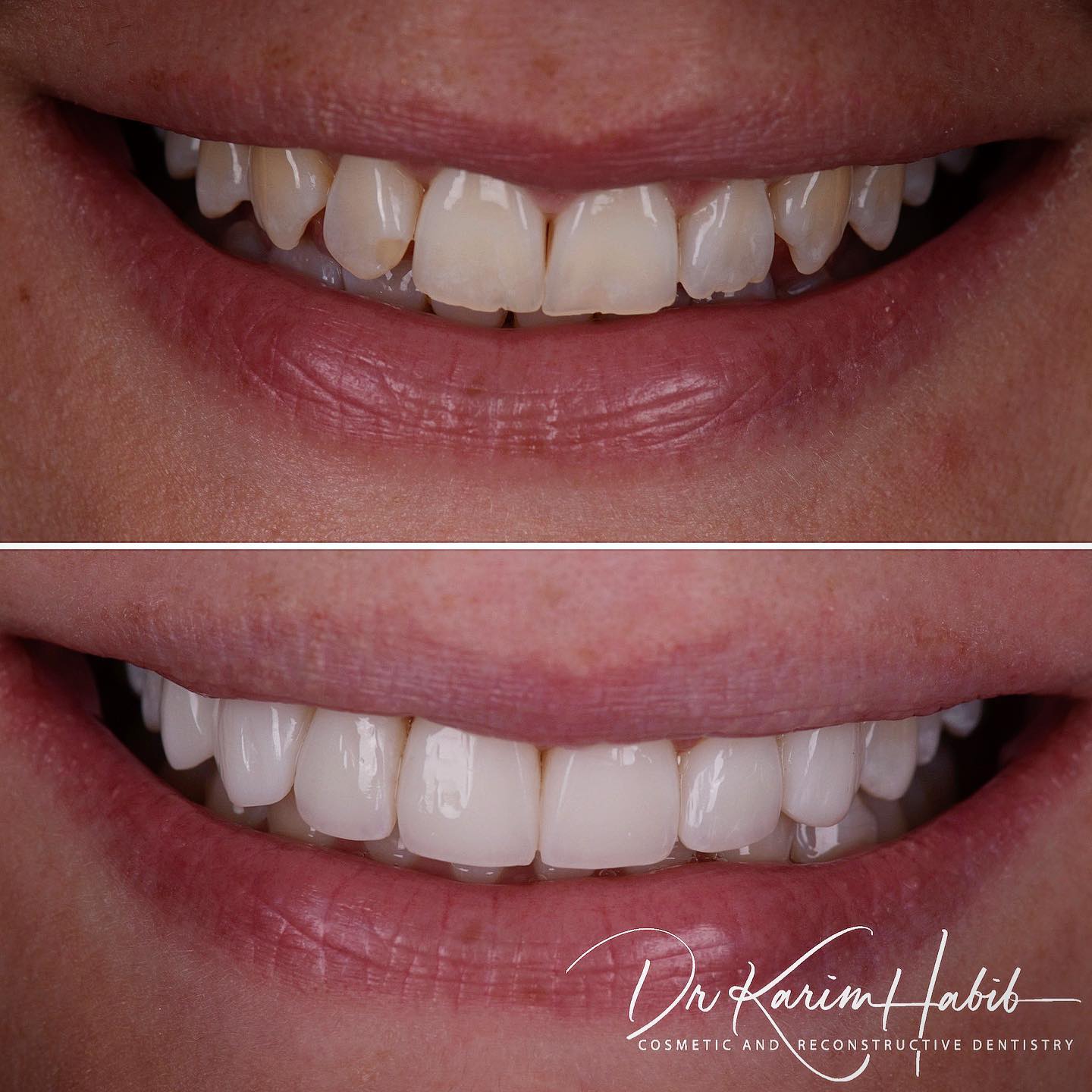 Composite Veneers Sydney