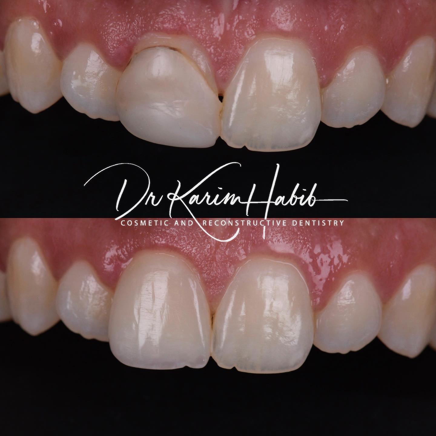 Composite Bonding Sydney