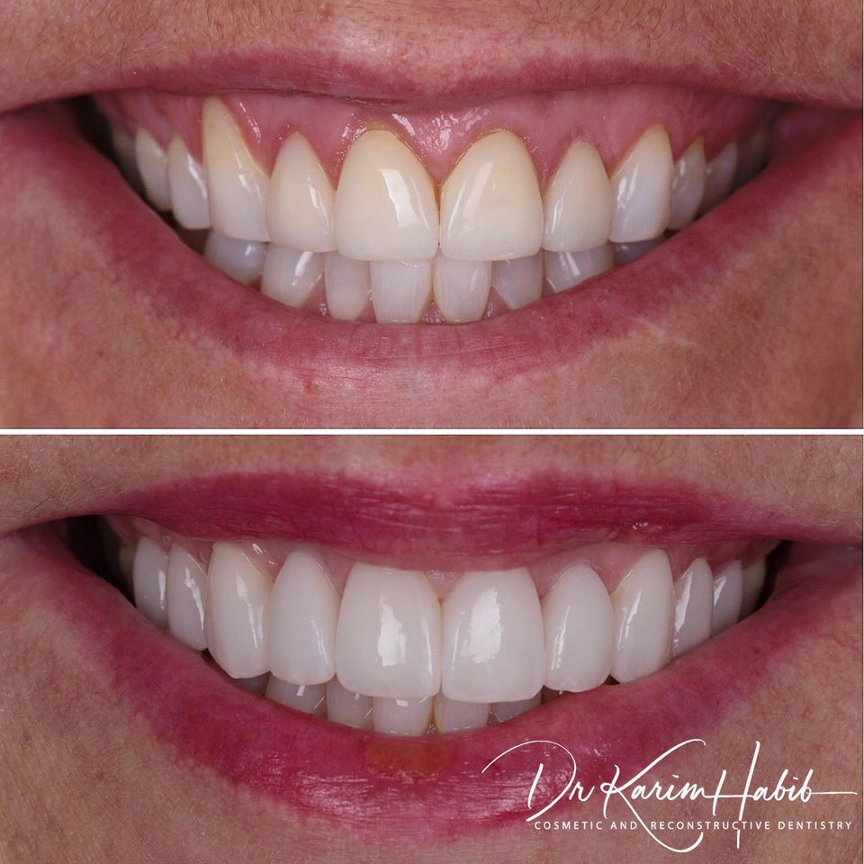 Porcelain Veneers sydney