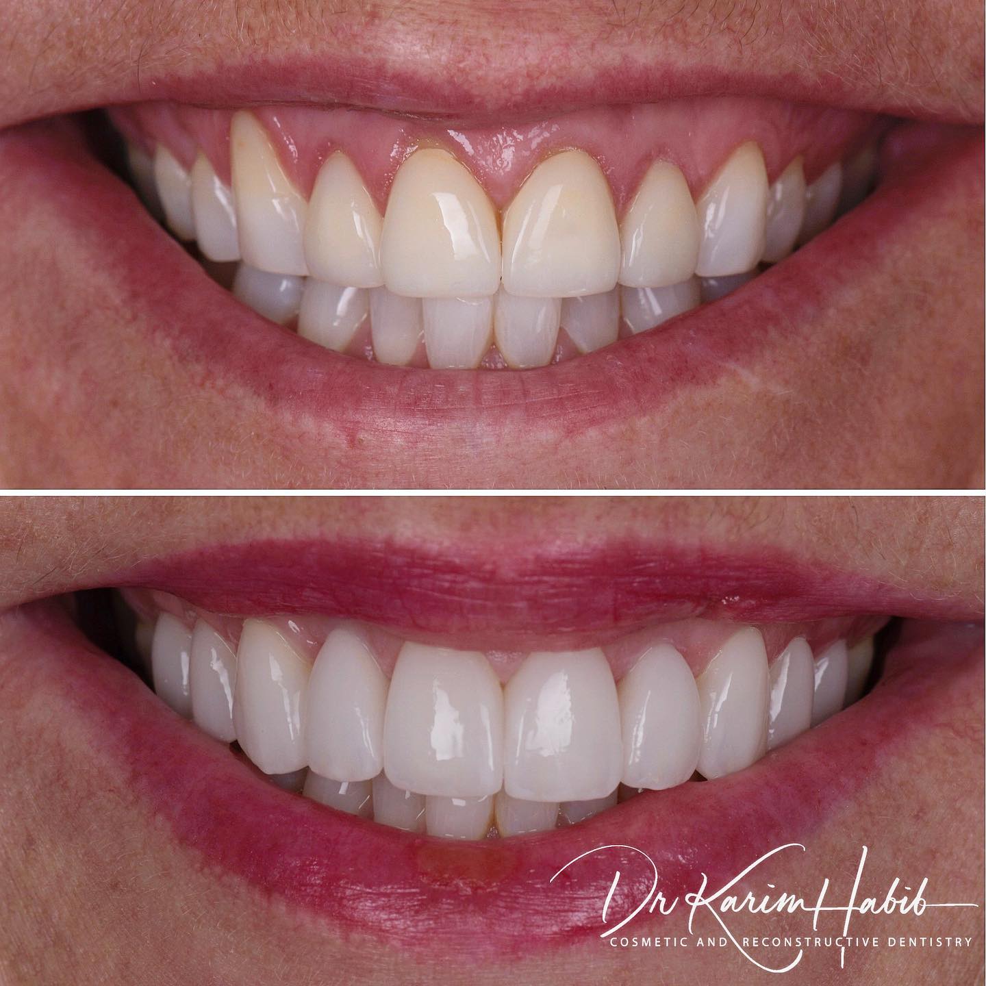 Porcelain Veneers and gum treatment