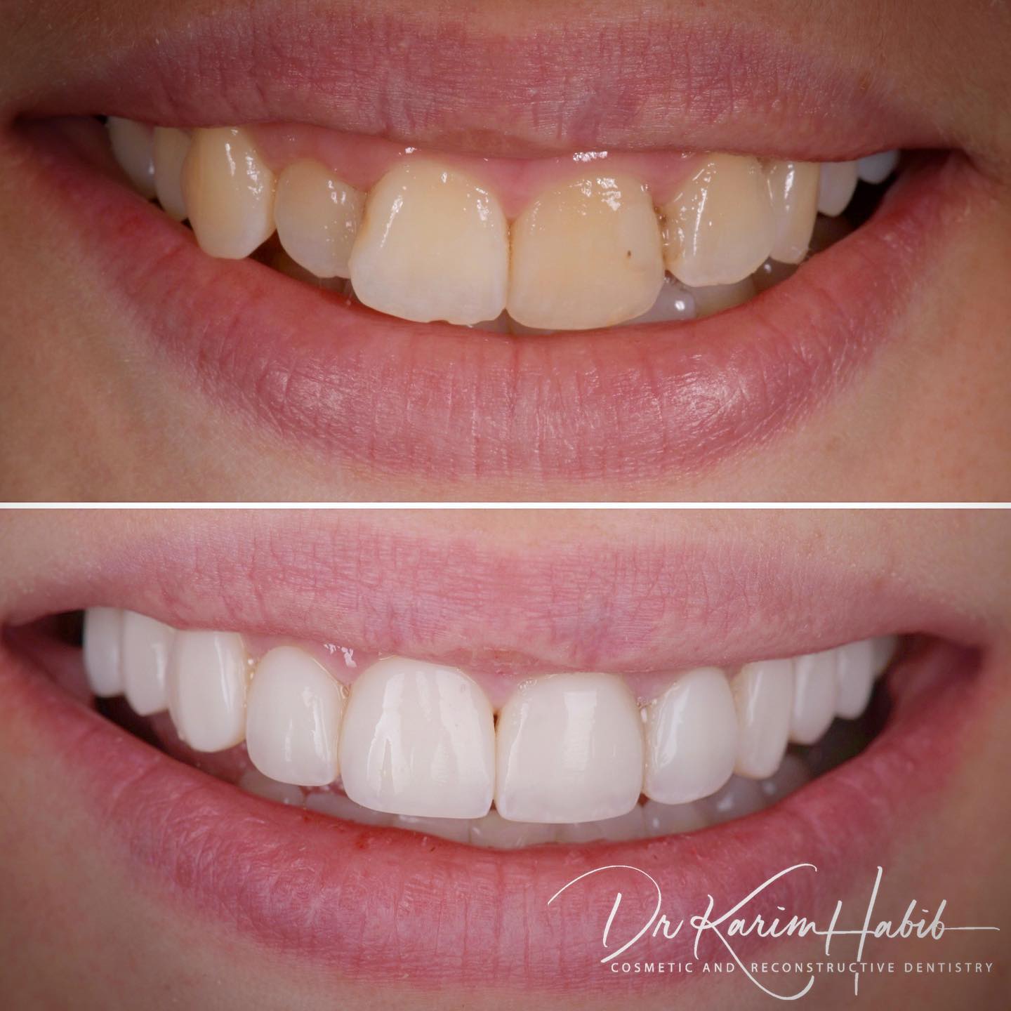 Invisalign and Composite Veneers