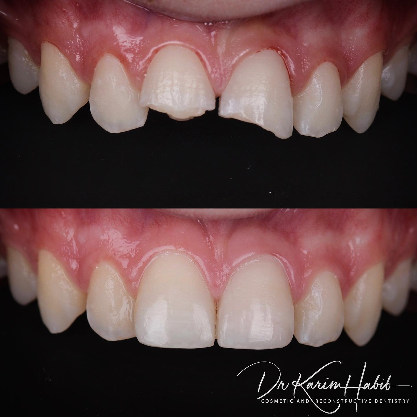 Broken teeth repaired with Composite Bonding