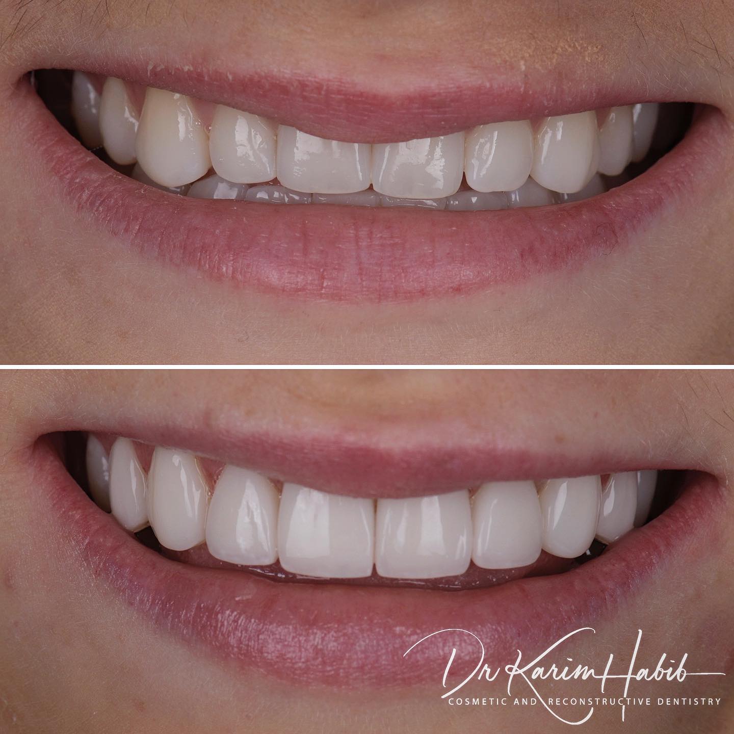 Reverse Smile Curve Correction with Veneers