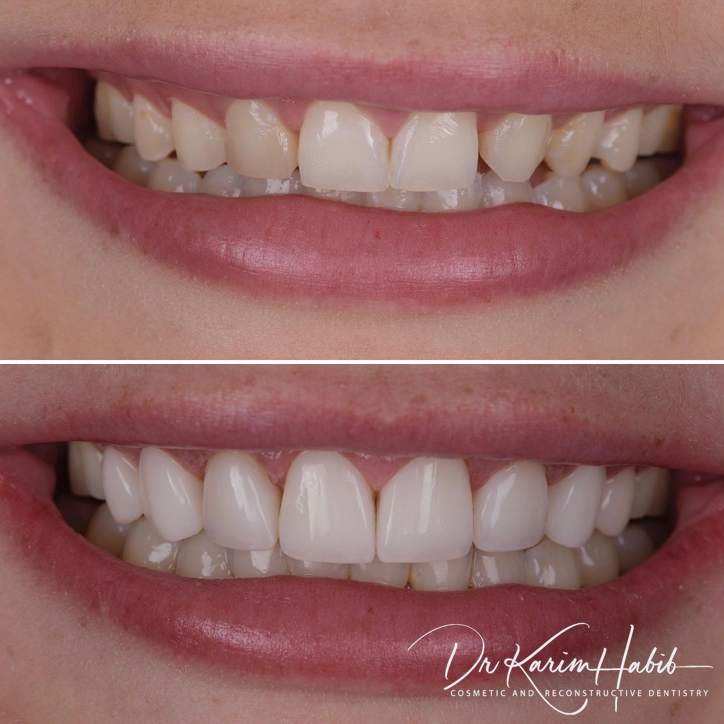 New Composite Veneers