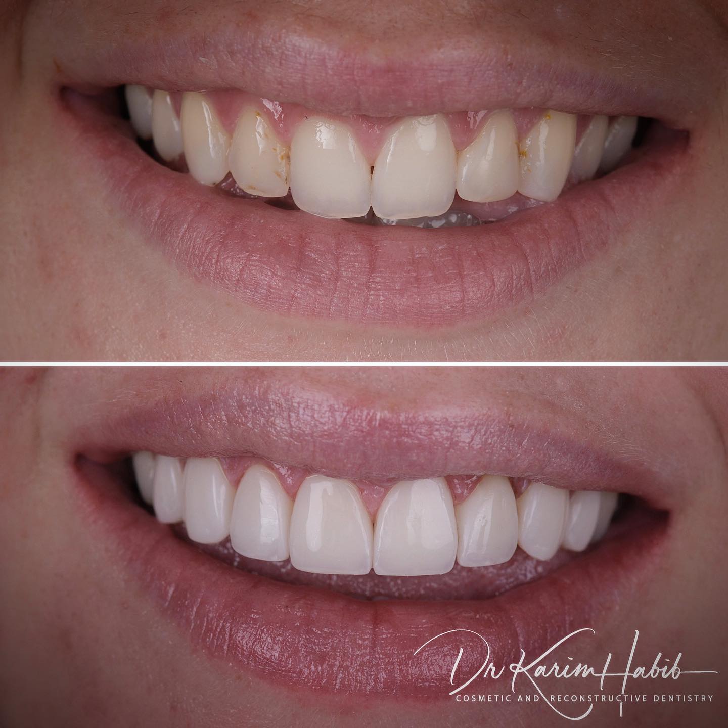 Composite Veneers Australia