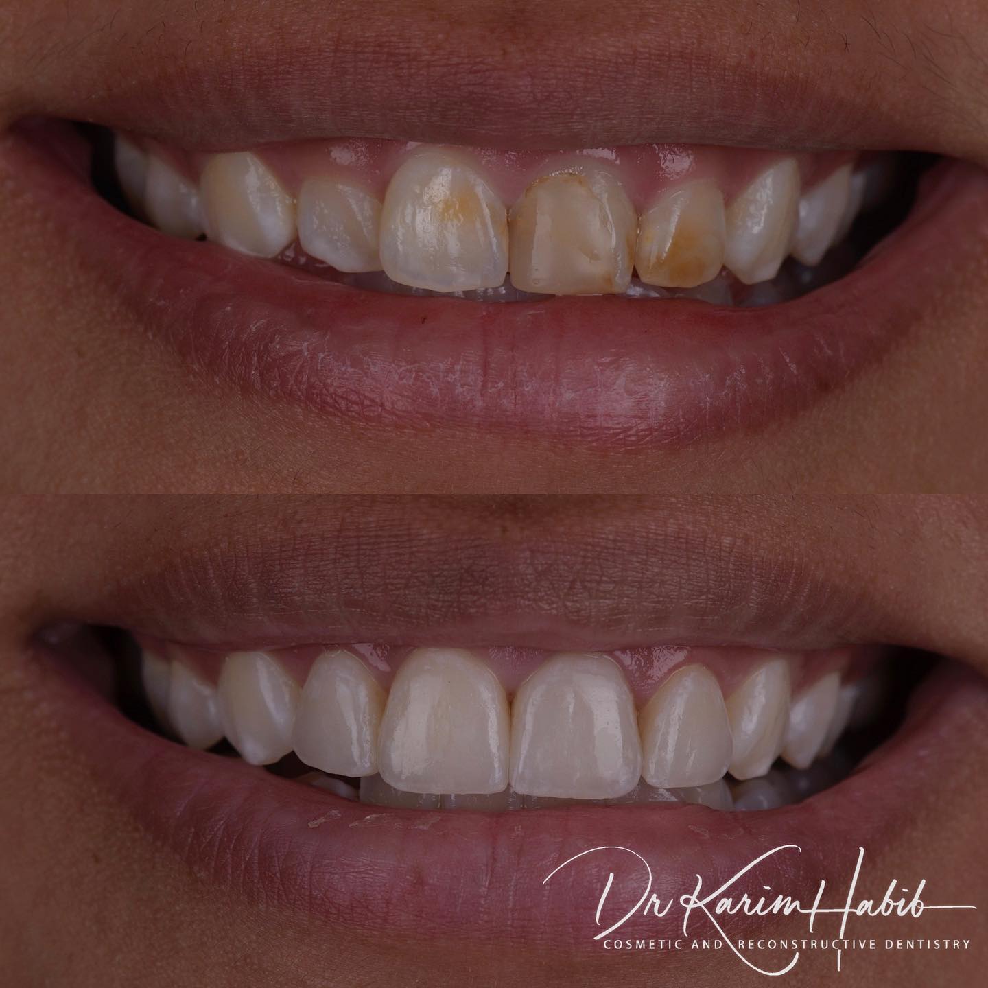 Very natural Porcelain Veneers