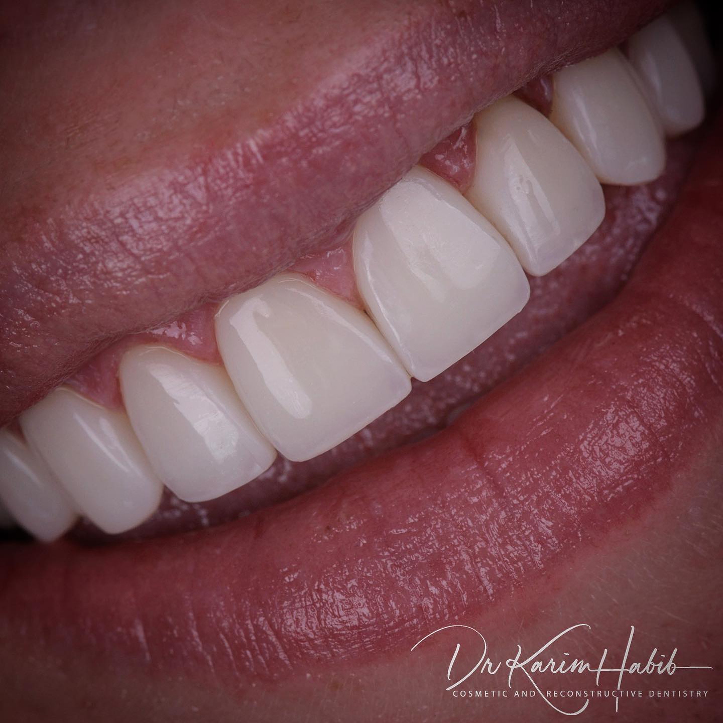 Composite Veneers Sydney Australia