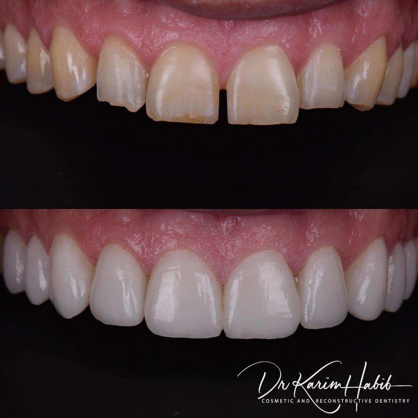 Top Quality Porcelain Veneers