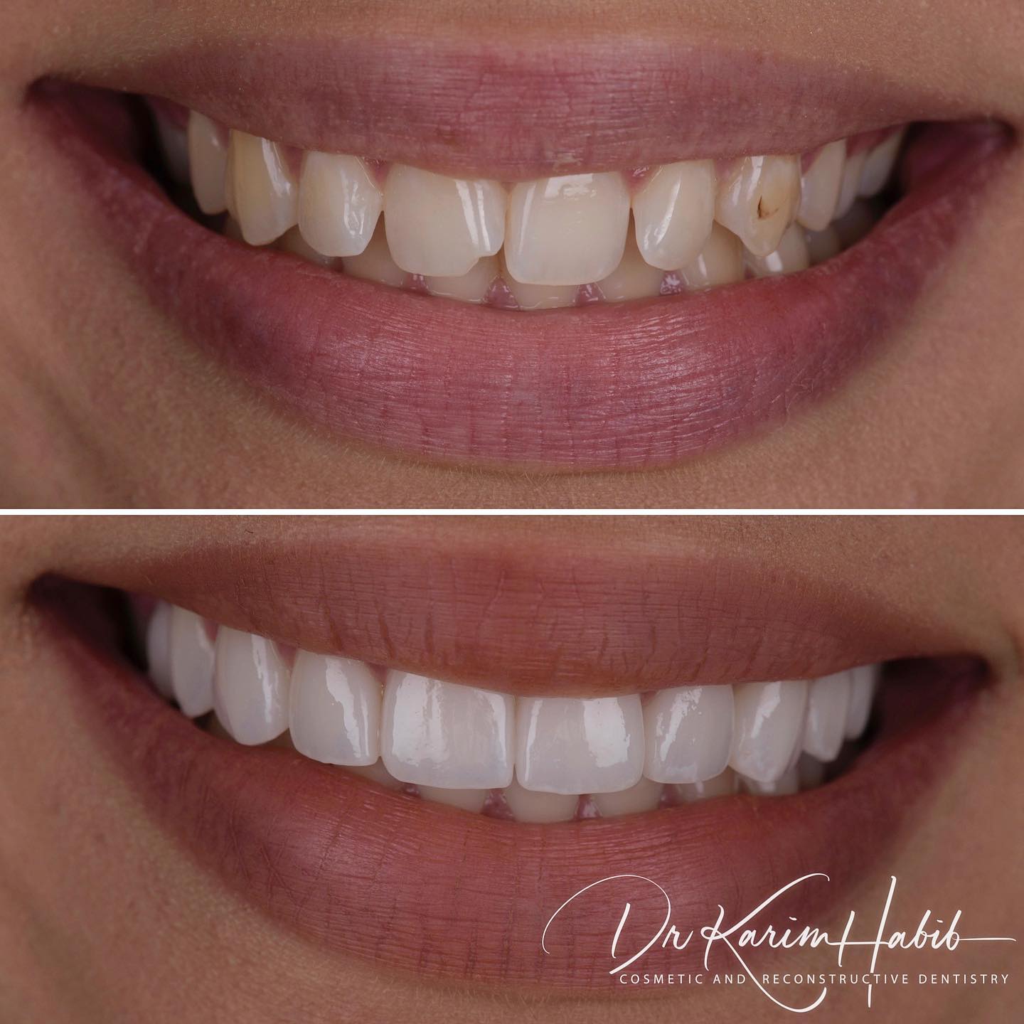 Porcelain Veneers cosmetic Dentist Sydney