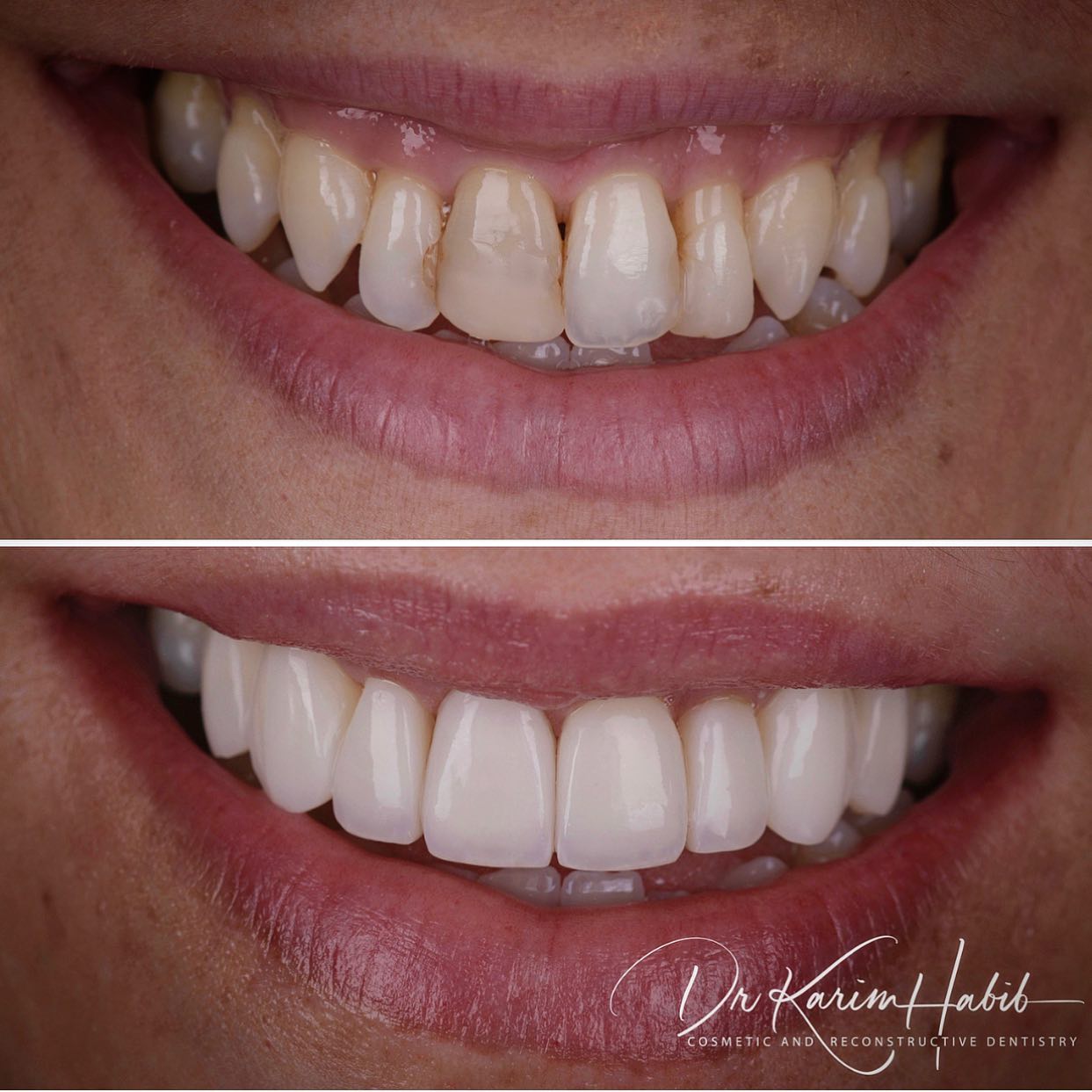 Extreme Makeover Composite Veneers