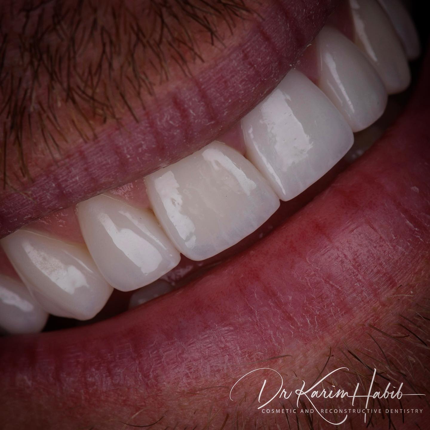 Natural and Beautiful Dental Veneers in Sydney