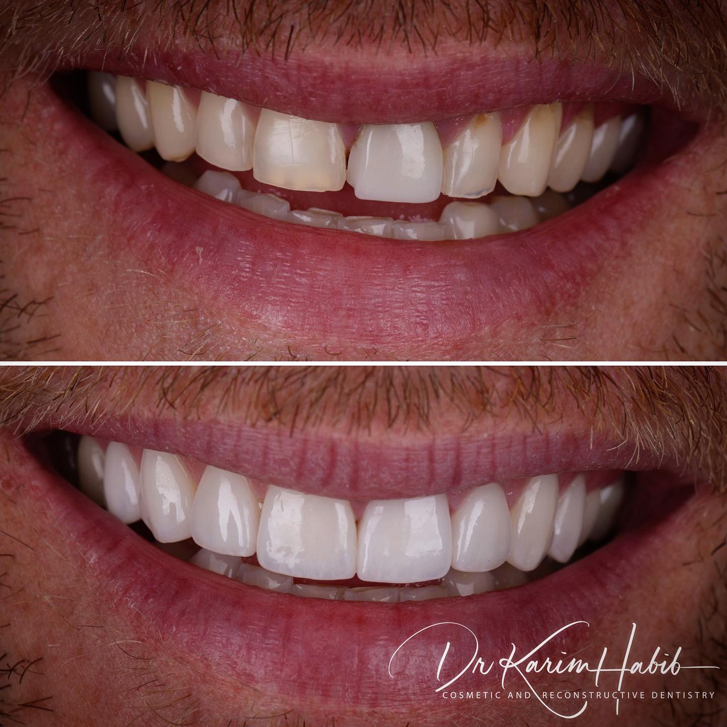 Porcelain Veneers Smile