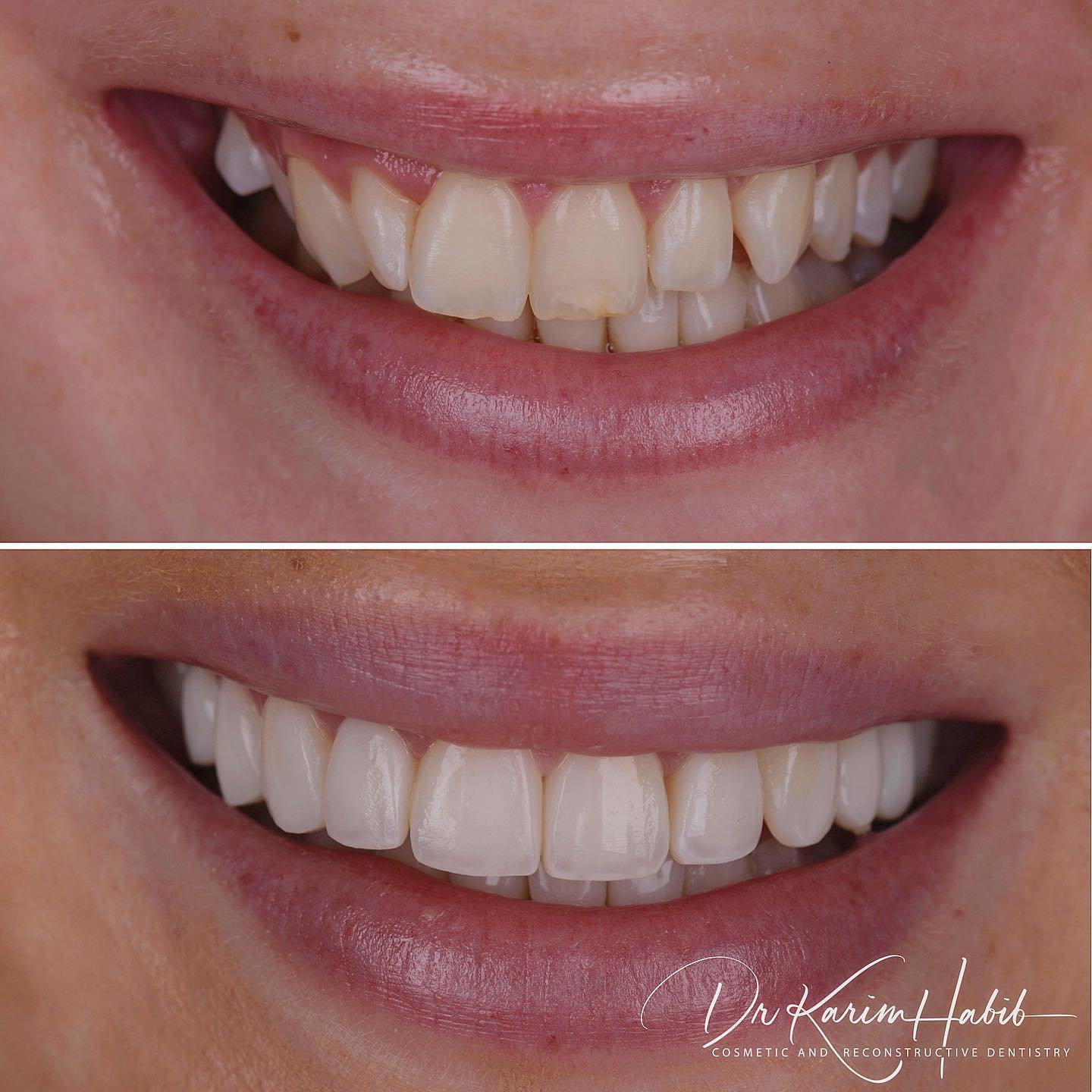 Invisalign and Veneers