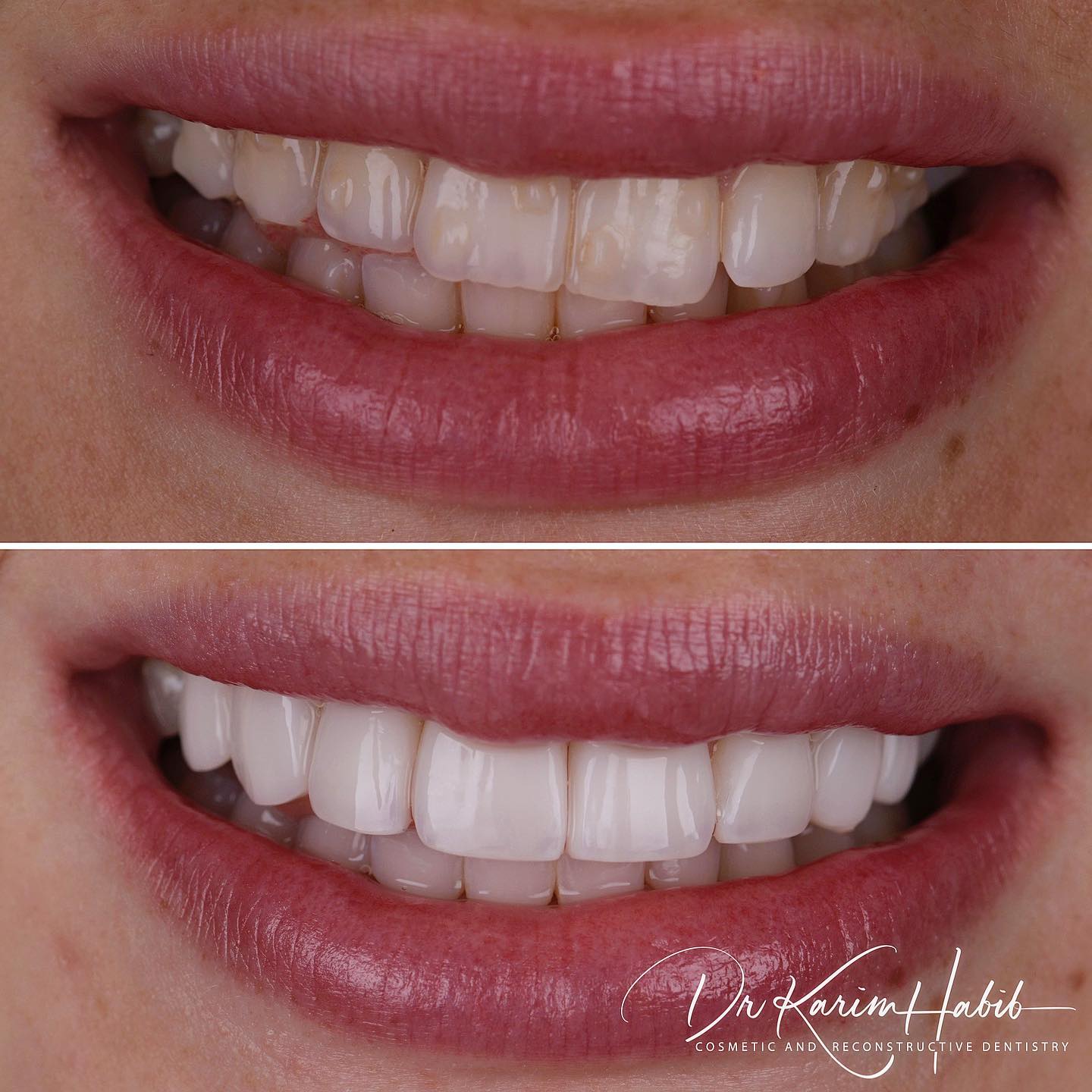 Composite Veneers Sydney Australia