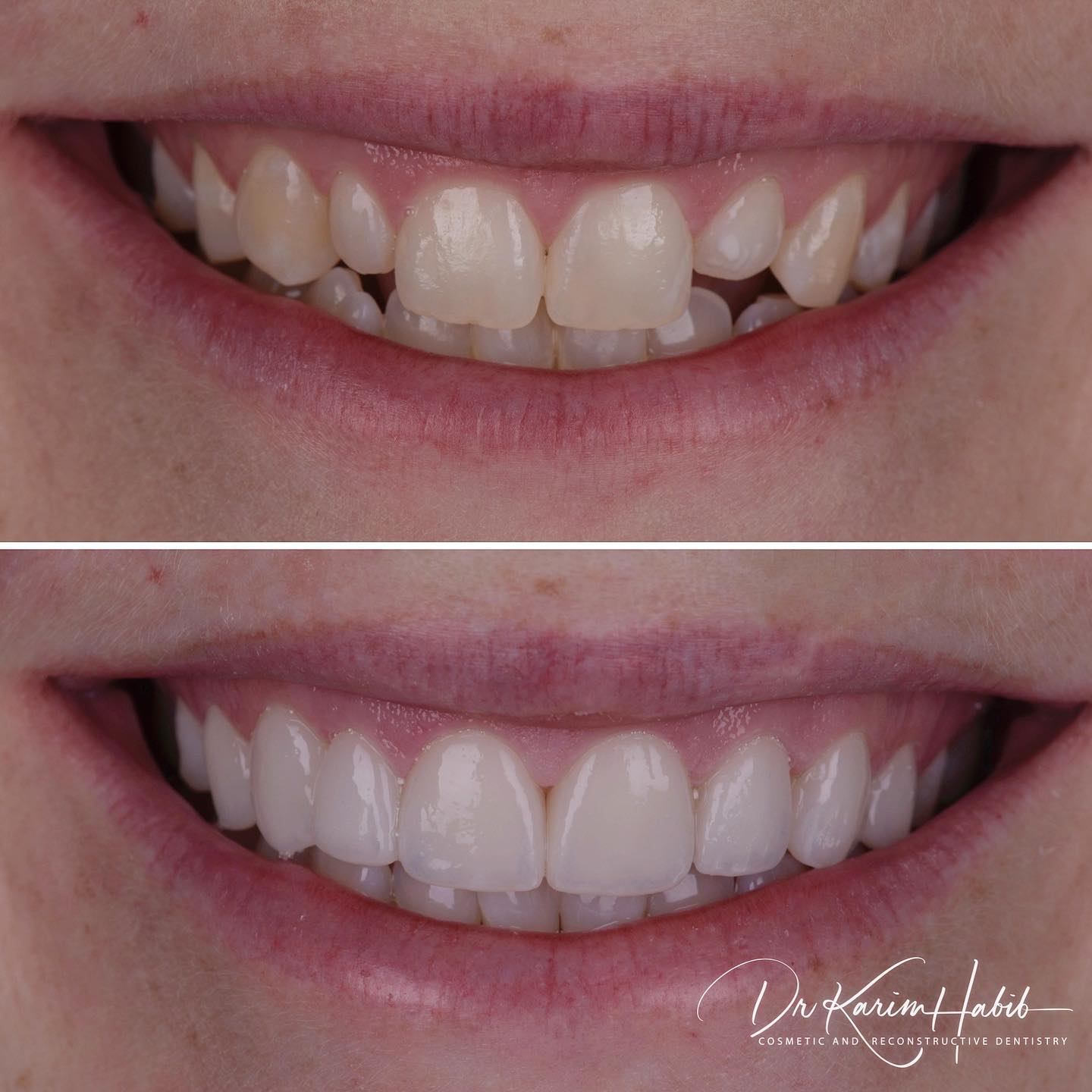 Porcelain Veneers Transformation