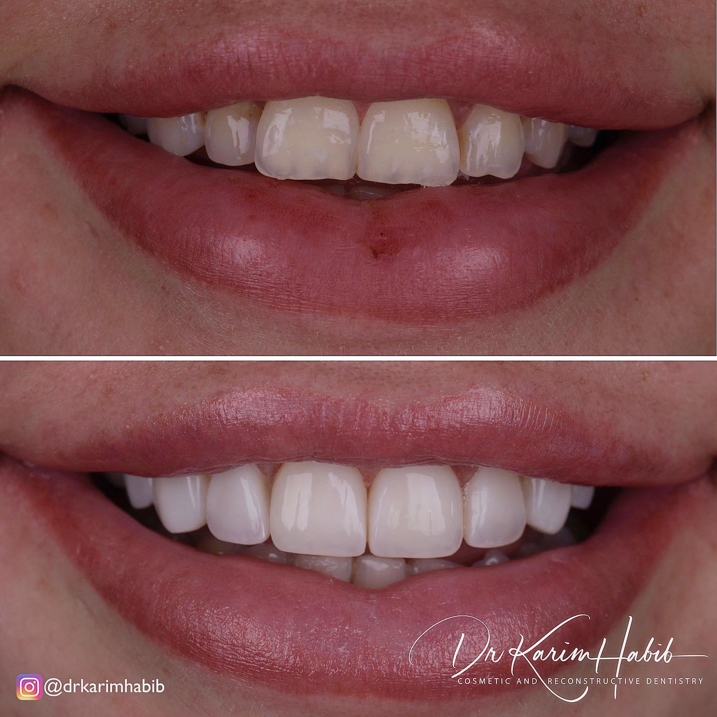 Natural and Glamorous Veneers