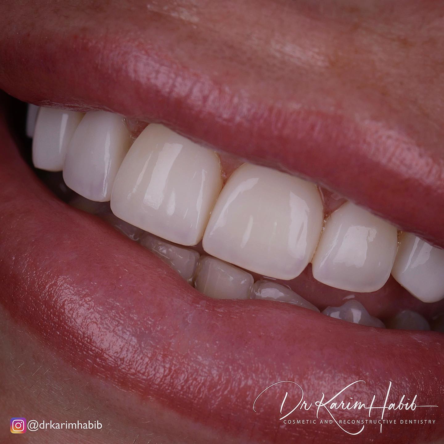 Best Veneers in Australia