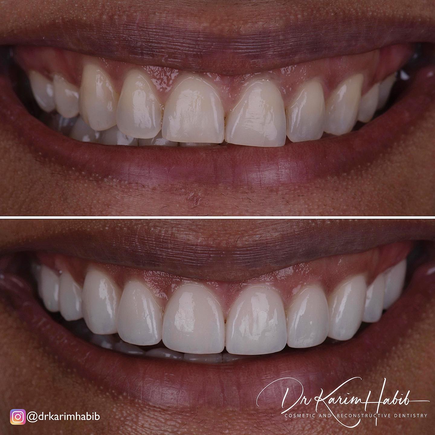 Smile Makeover Porcelain Veneers