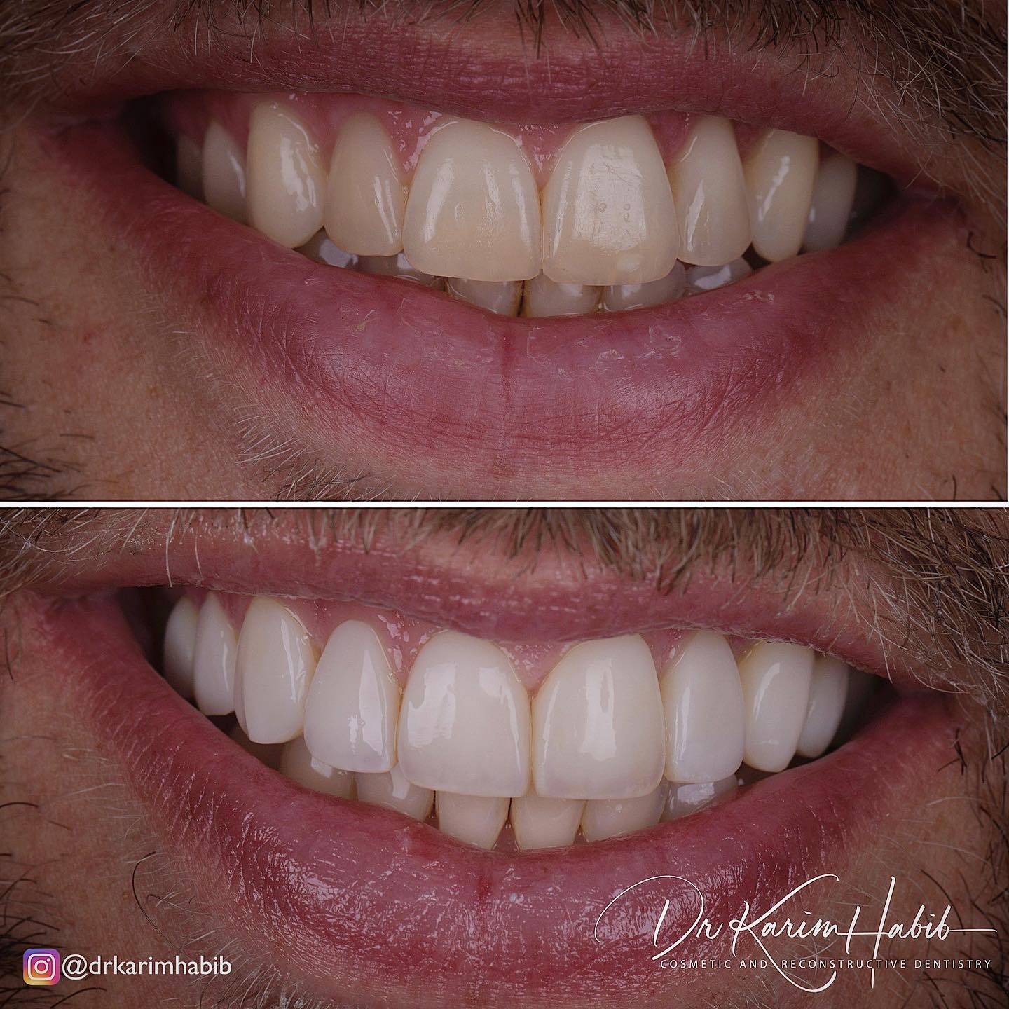 cosmetic dentist sydney composite veneers