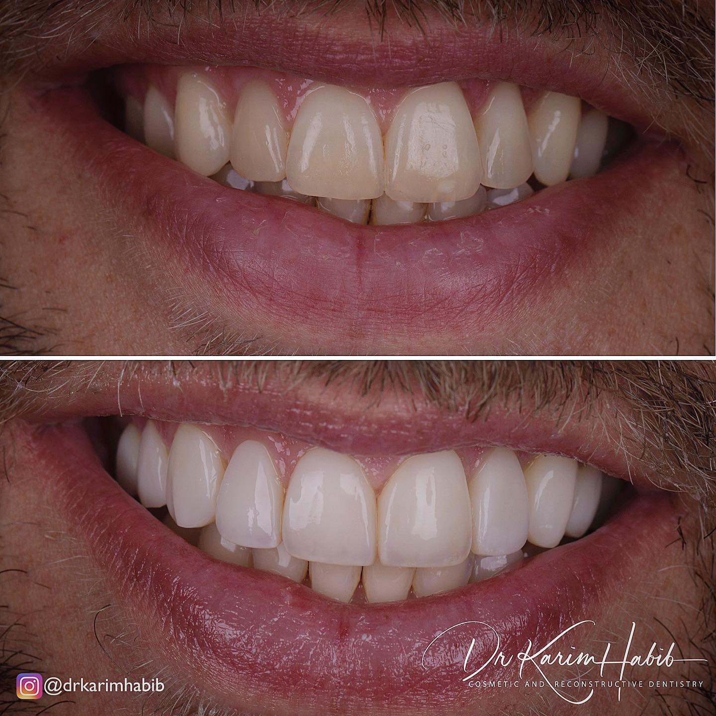 Composite Veneers Sydney Experts