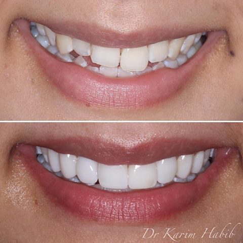 Best Composite veneers sydney