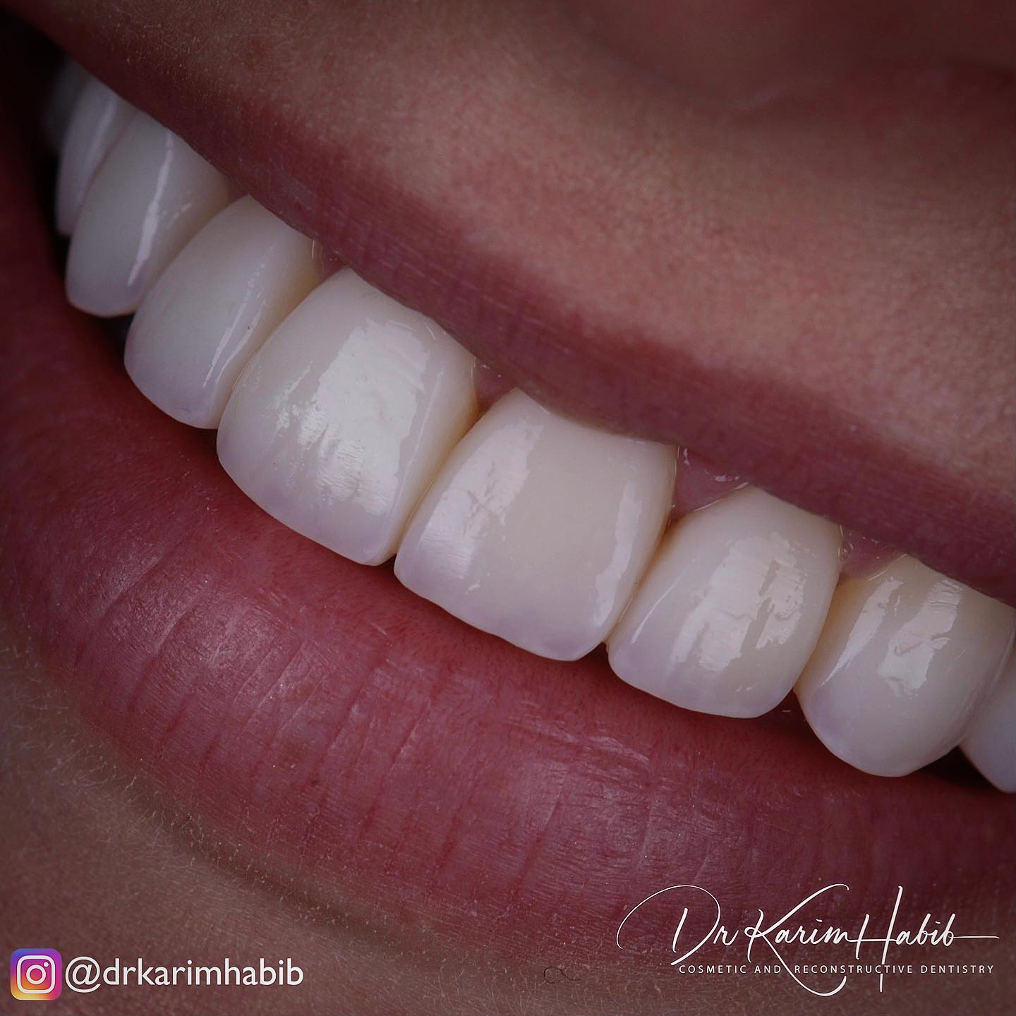 Natural composite veneers Sydney