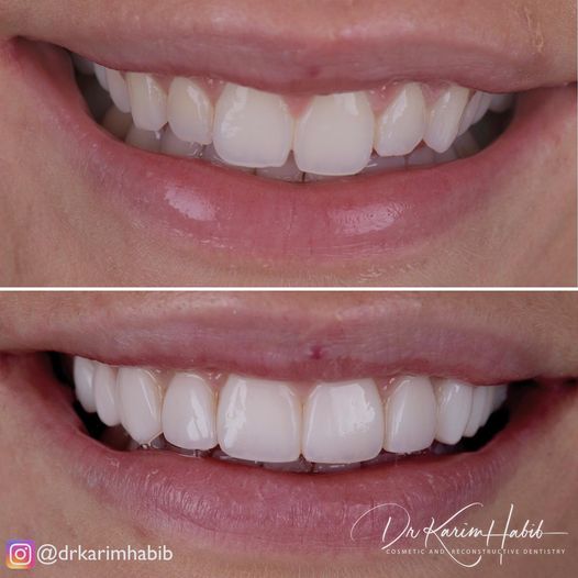 Composite Veneers Sydney