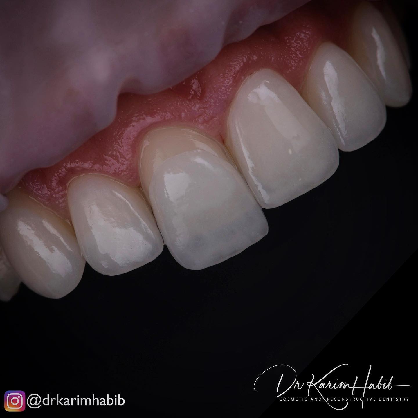 No Prep veneers sydney