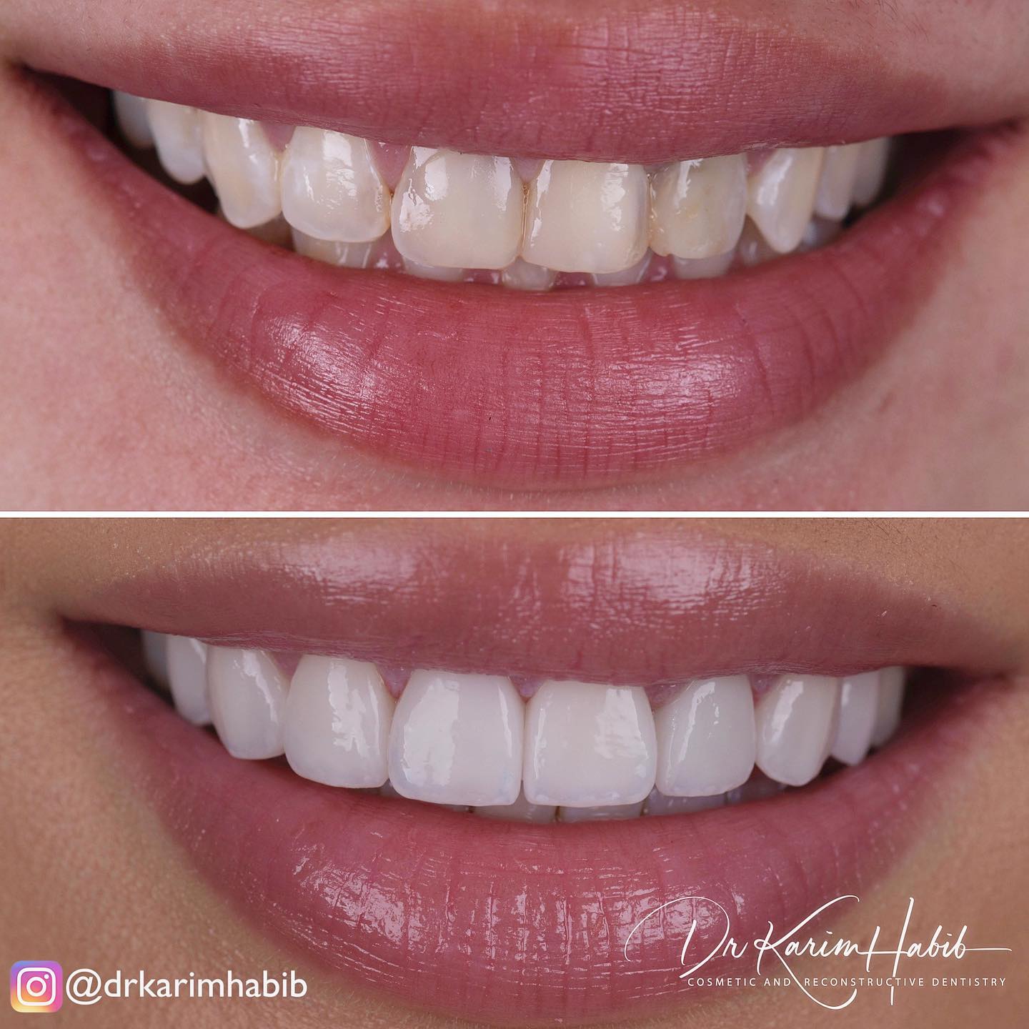 Bright Teeth Veneers