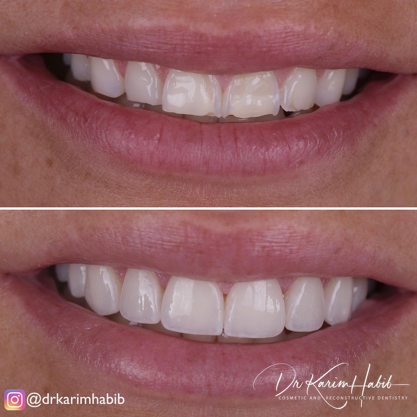 Porcelain Veneers Sydney