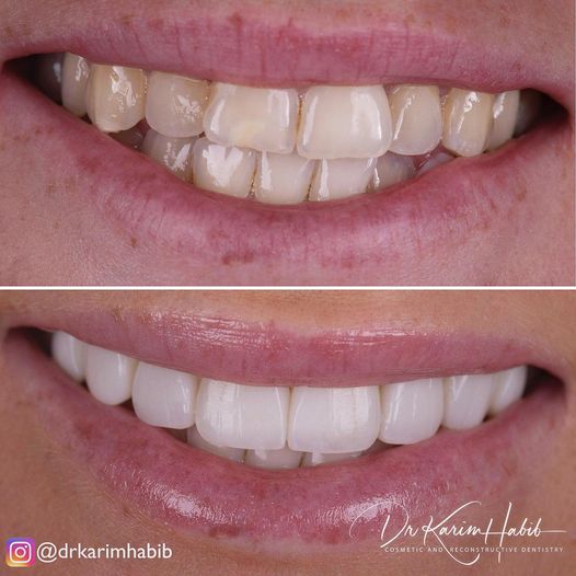 Sydney Smile Makeover dental veneers