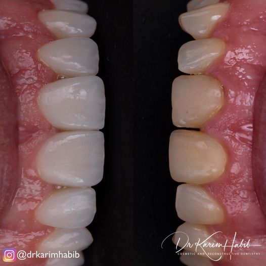 Natural Porcelain Veneers Experts