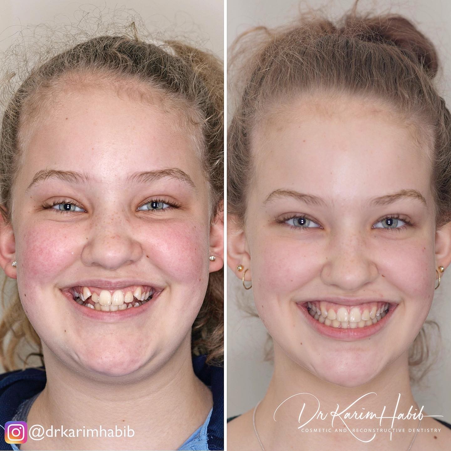 Braces treatment beautiful Smile