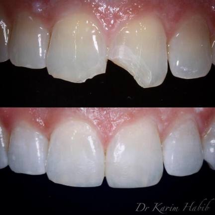 Composite Bonding Chipped tooth repair