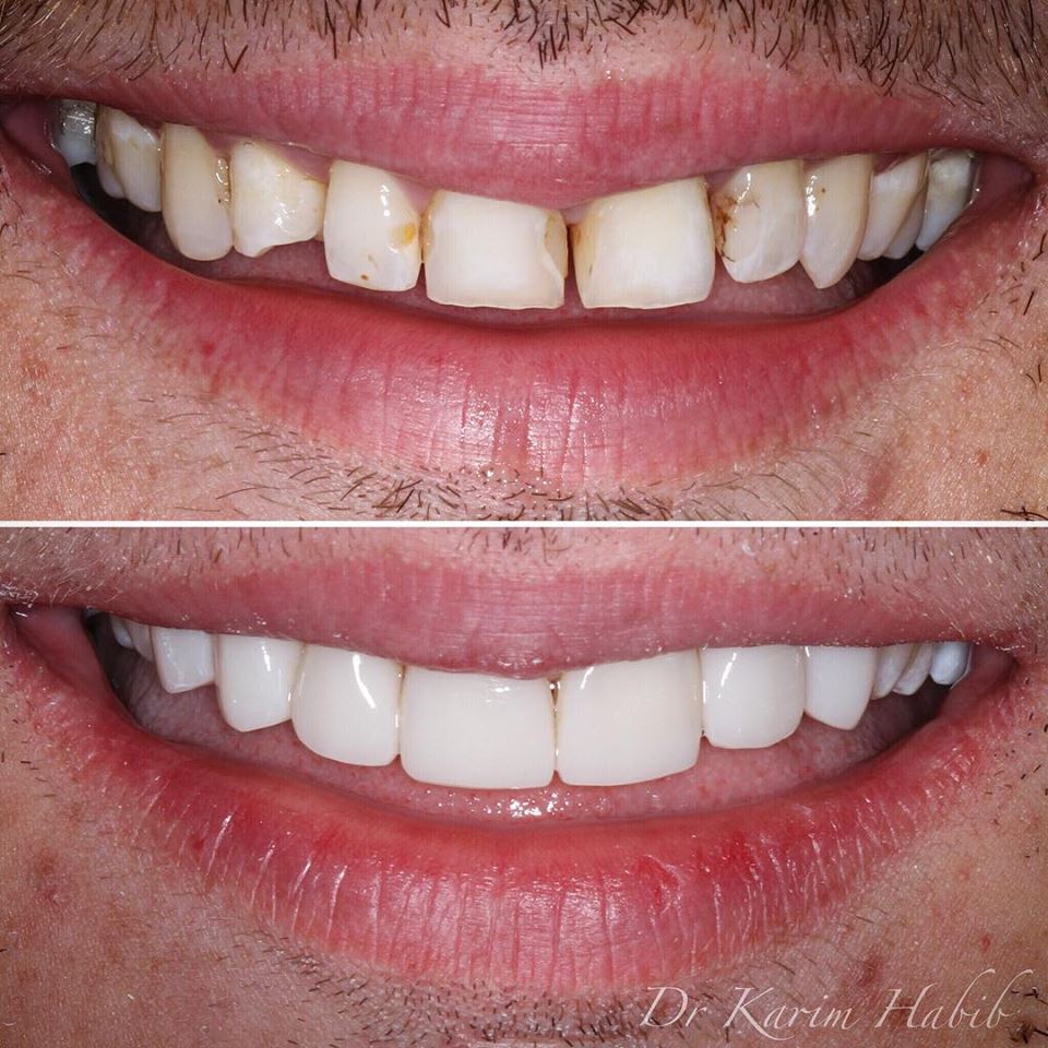 Smile makeover veneers