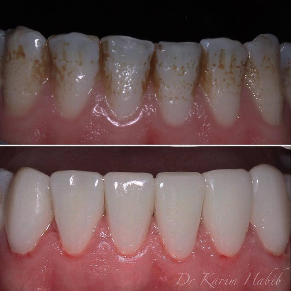 Composite veneers on lower teeth