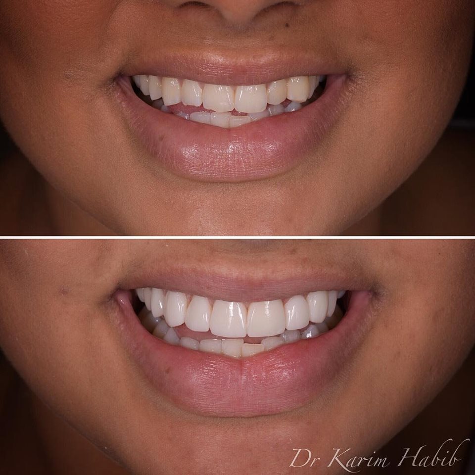 Sydney Veneers