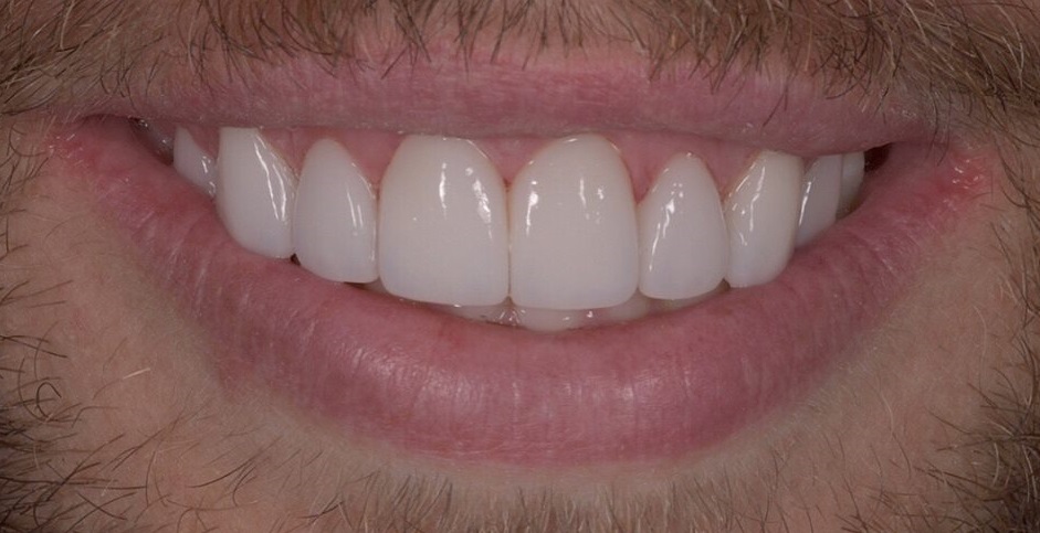 Porcelain Veneers Sydney with Gum lift