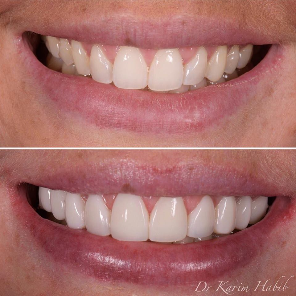 Natural Directly bonded Composite Veneers in sydney