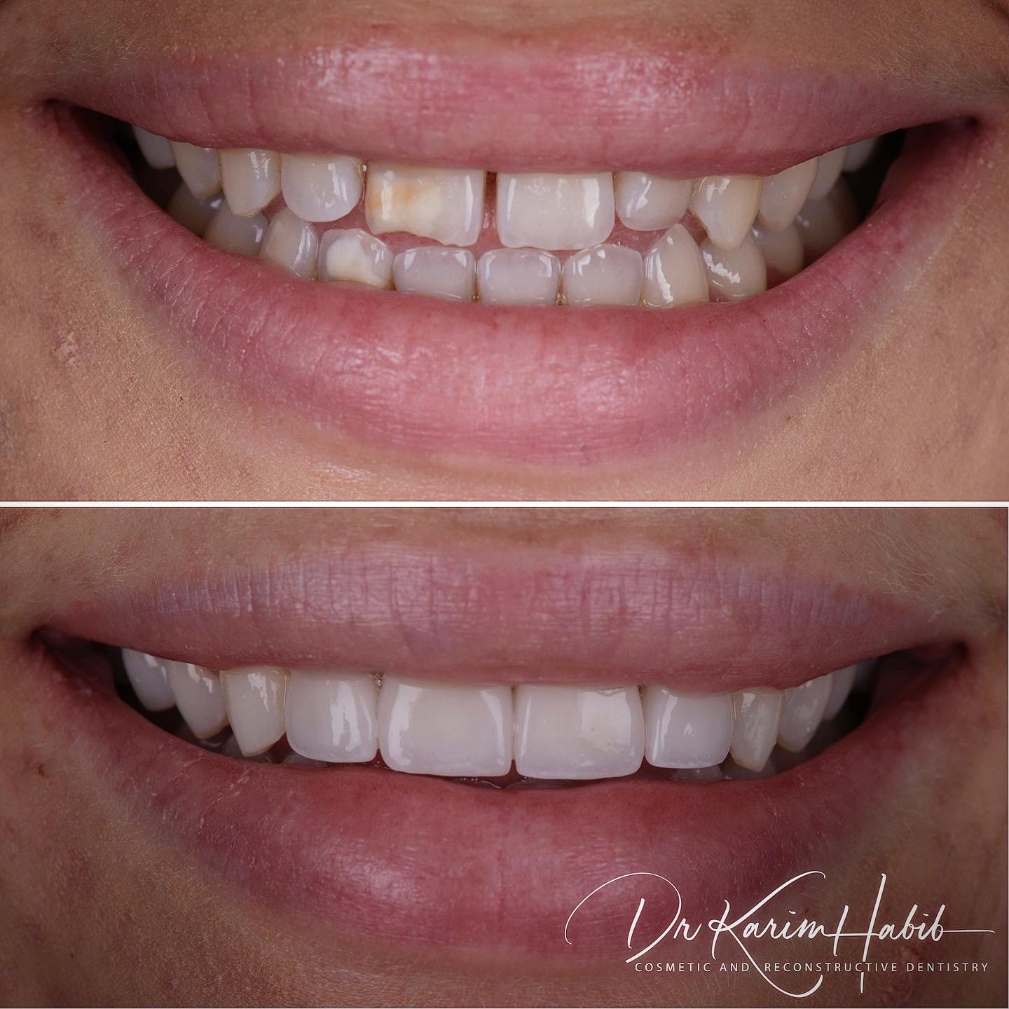 Porcelain Veneers Sydney