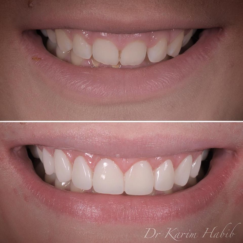 gum contouring and veneers