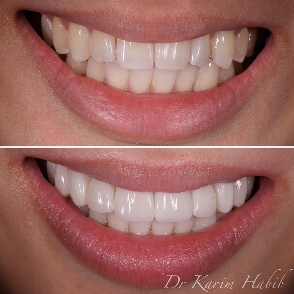 Natural looking composite veneers by Dr Karim Habib