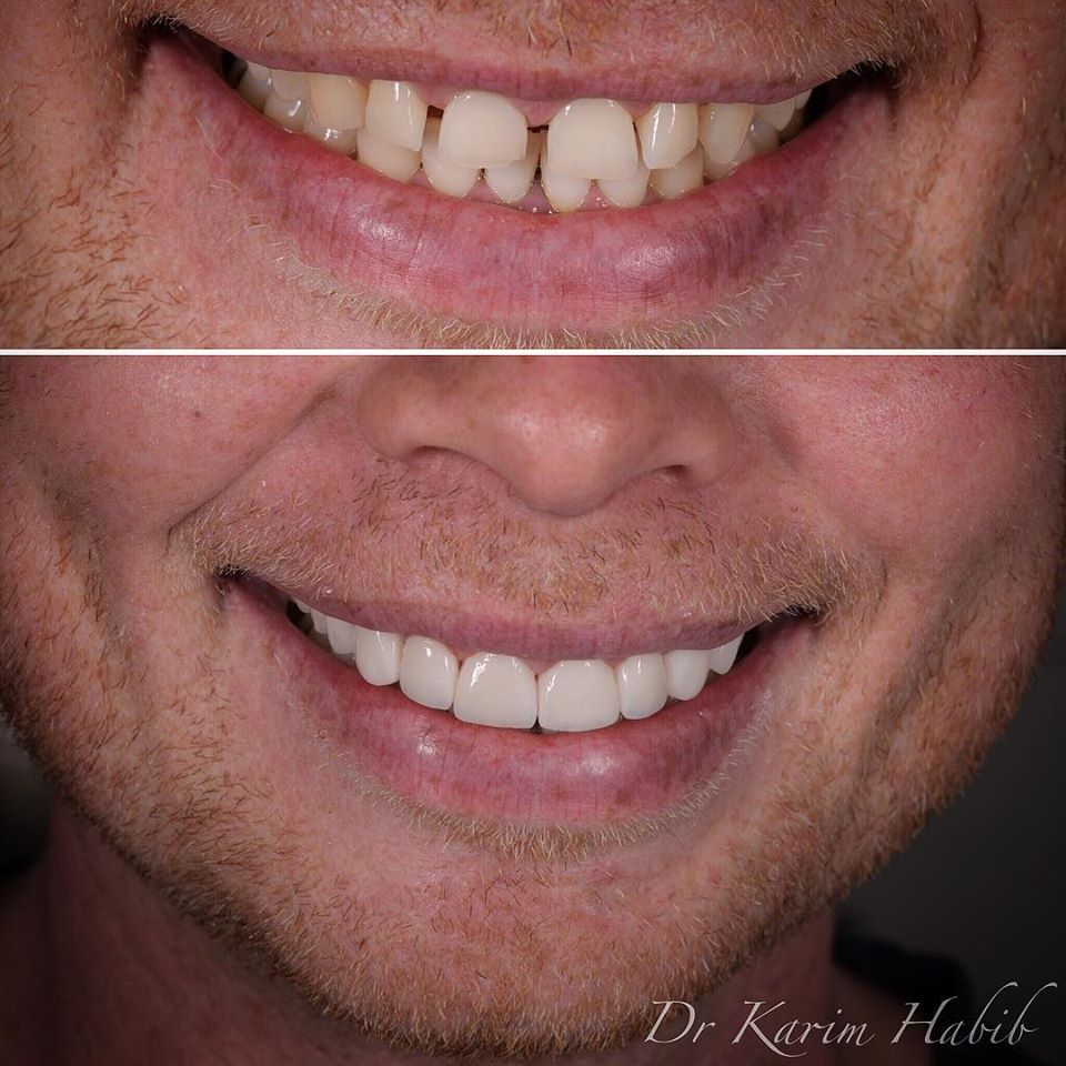 No-prep composite veneers to close spaces