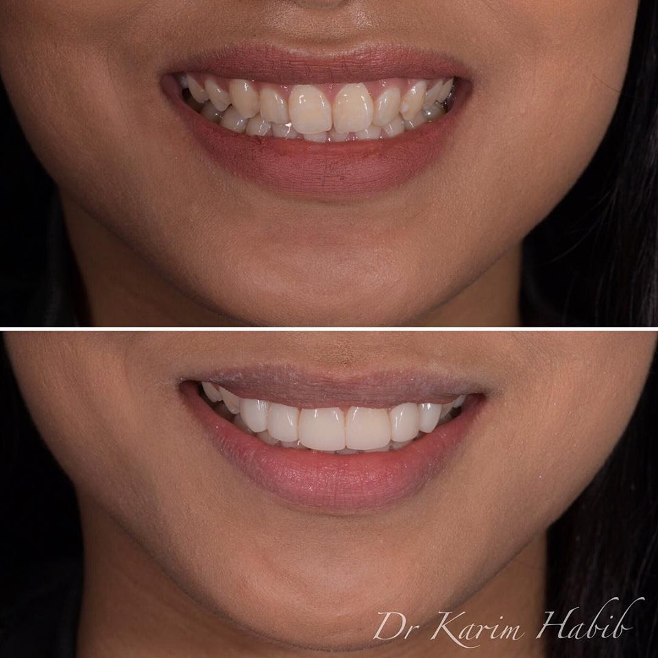 Sydney Dental Veneers