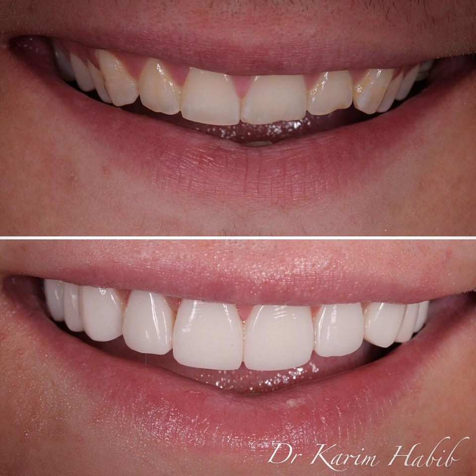 Hand-layered composite veneers by Sydney cosmetic dentist Dr K.Habib