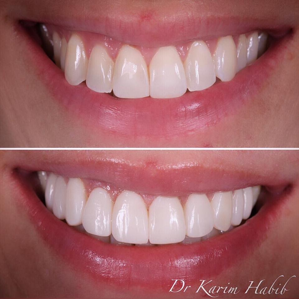 Natural Sydney composite dental veneers