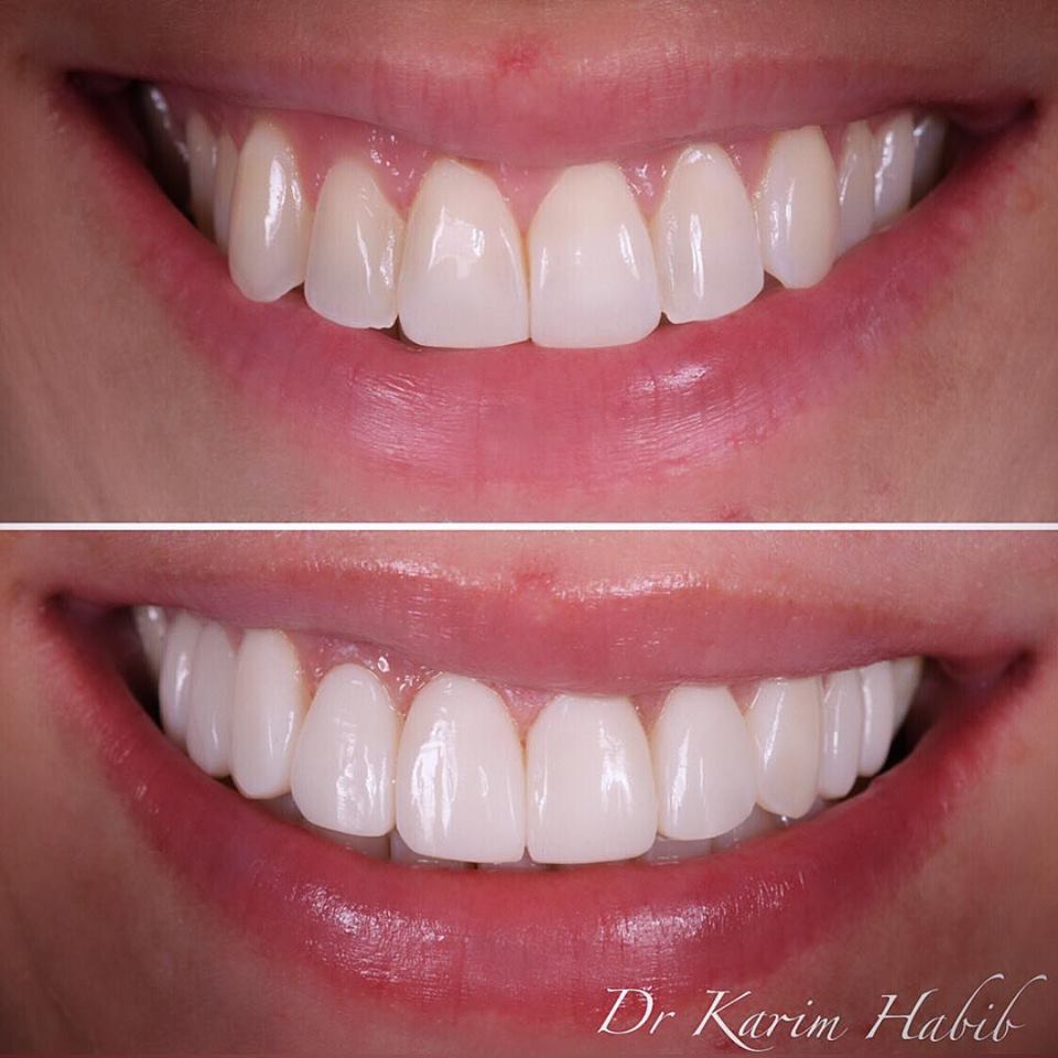 Natural Sydney composite dental veneers