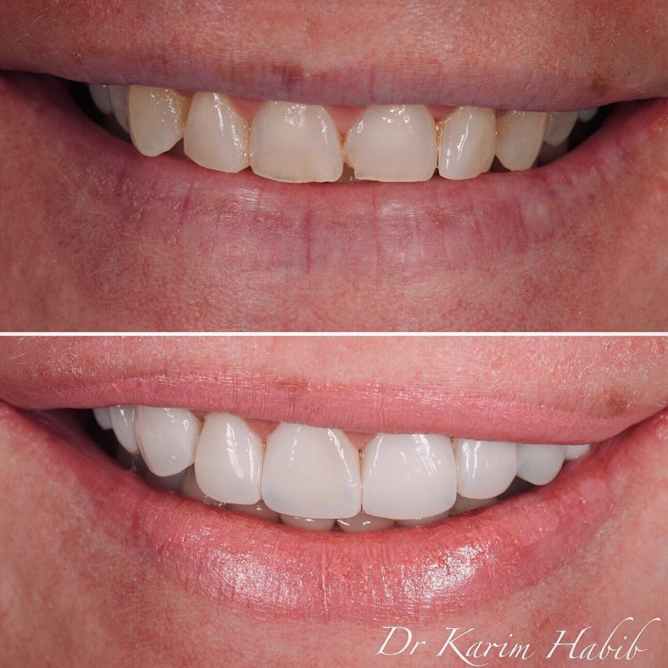 Natural hand-layered composite veneers in Sydney